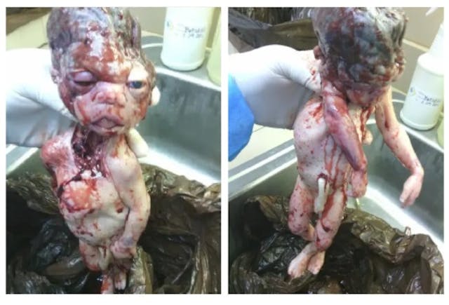 Aborted baby images to Operation Rescue from staff at Houston abortion facility operated by Douglas Karpen Images: Aborted baby images to Operation Rescue from staff at Houston abortion facility operated by Douglas Karpen