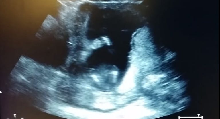 ultrasound