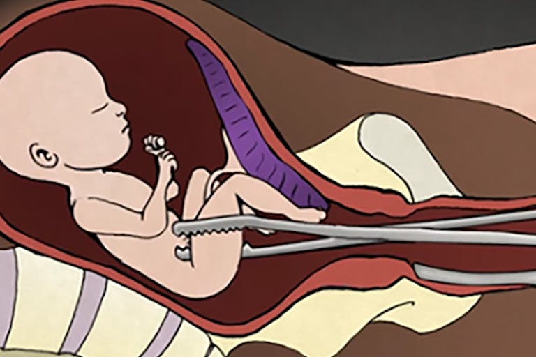 late-term abortion, D&E Abortion, Go to www.AbortionProcedures.com for facts on abortion