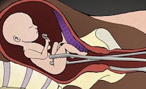 late-term abortion, D&E Abortion, Go to www.AbortionProcedures.com for facts on abortion