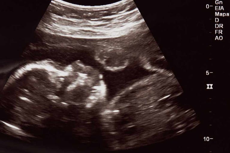 abortion takes a human life