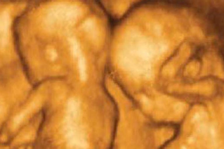 twins, abortion pill reversal, selective reduction