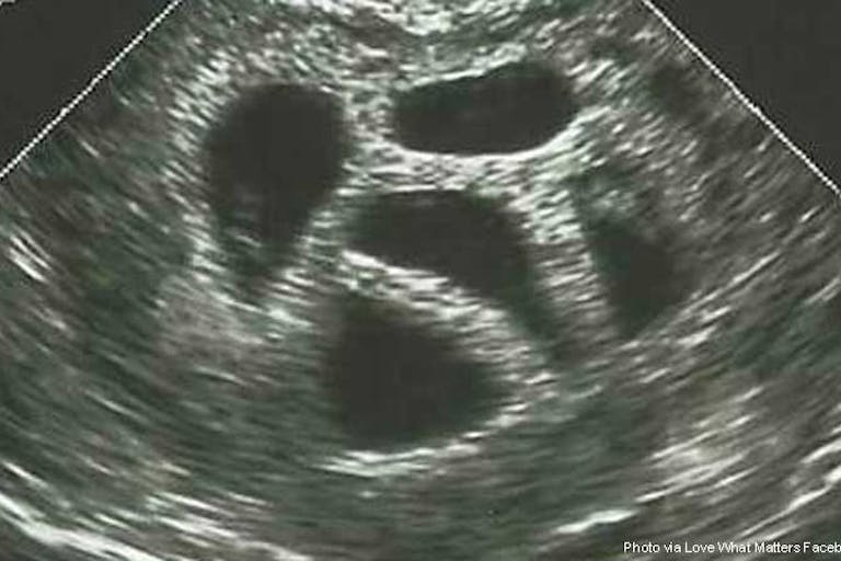 quintuplets-susan-thompson