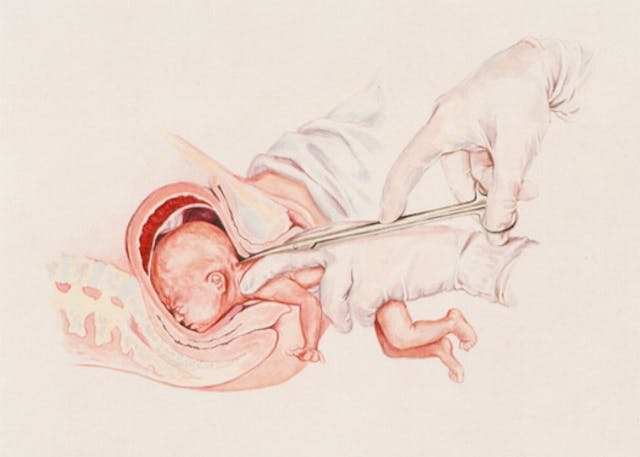 Medial diagram of a partial-birth abortion procedure where the child is delivered breech, except for the head. illustration of D&X partial birth abortion