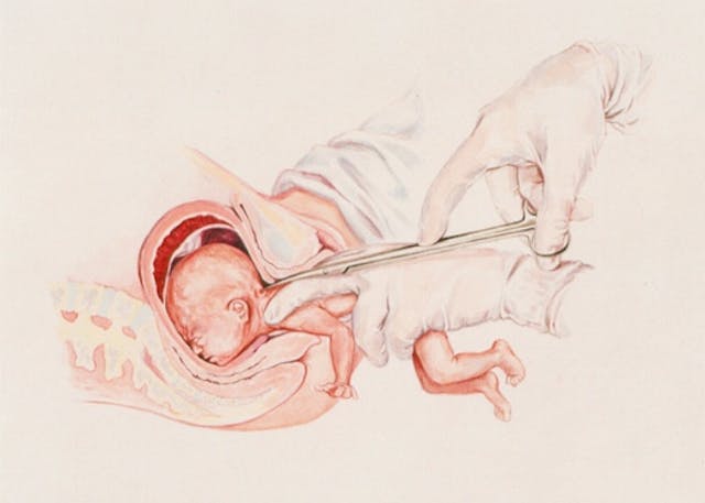 illustration of D&X partial birth abortion