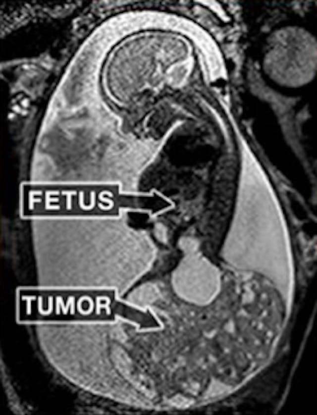 A scan of Macie and her tumor. A scan of Macie and her tumor.