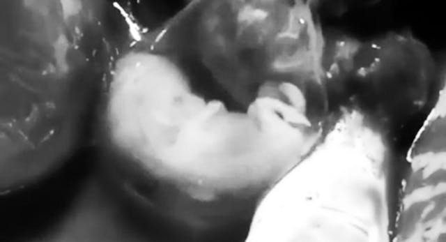 A preborn child removed during an ectopic pregnancy. ectopic pregnancy humanity