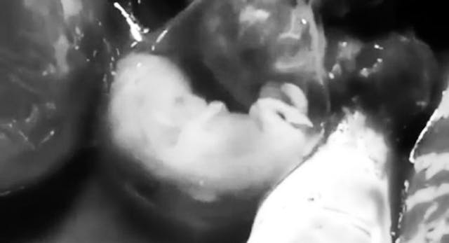 ectopic pregnancy humanity