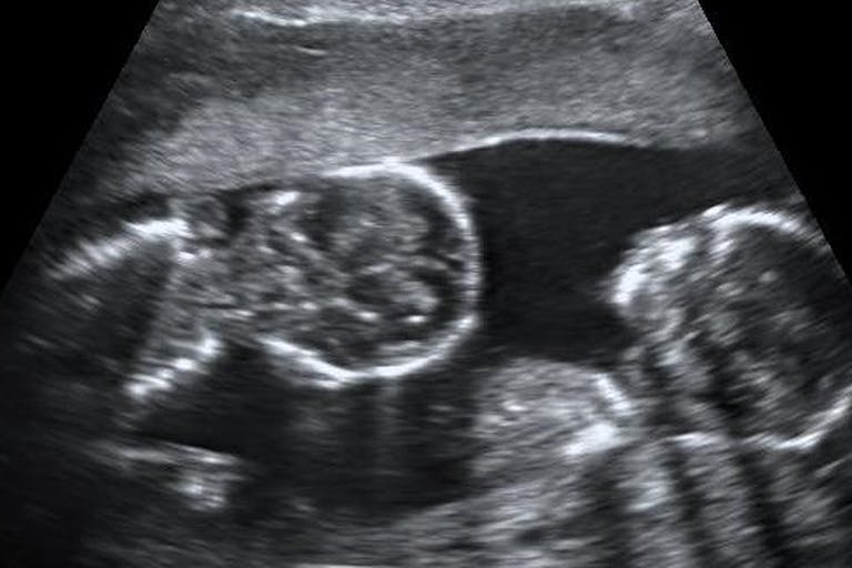 monoamniotic_twins_at_15_weeks