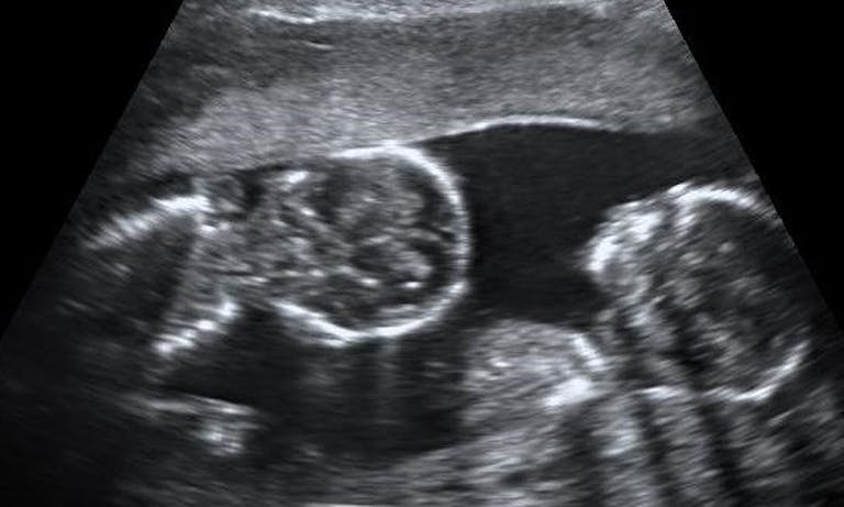 monoamniotic_twins_at_15_weeks
