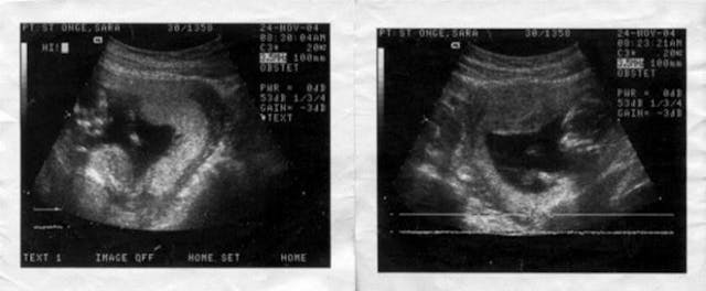 Saras-baby-sonogram-photo