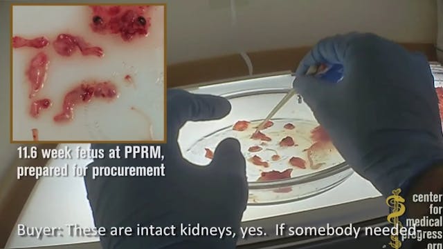 Planned Parenthood staff examine the human fetal remains following an abortion at 11 weeks. PP-CMP