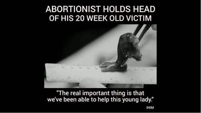 Screenshot of the leg of a dismembered 20-week old preborn child killed by a D&E abortion in the documentary Lake of Fire. Sorry, VICE. Abortionists’ own words prove this Live Action abortion video is accurate image