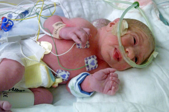BRAIN TUMOUR BABY