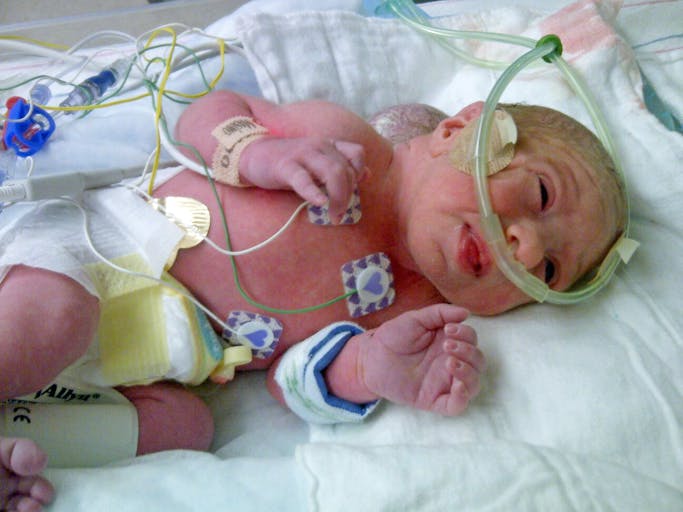 BRAIN TUMOUR BABY