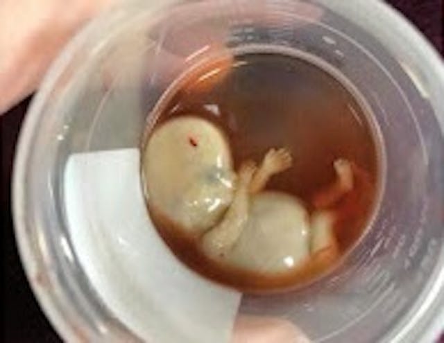 Baby Nielson was miscarried at 11 weeks gestation. Miscarriage in the age of abortion: Women aren’t mourning ‘a jumble of cells’ image