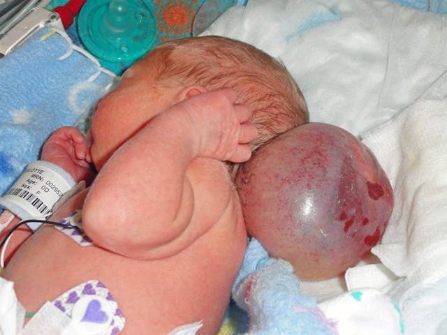 PIC FROM CATERS NEWS - (PICTURED: Isabella before her surgery.) - An adorable four year old born with her brain growing outside her skull has made a miraculous recovery and she is now hitting all her milestones. Isabella Grote, from Minot, North Dakota, USA, was born with a rare birth defect Encephalocele causing part of her brain to grow through an opening at the back of her skull. Doctors told distraught parents, Sharlotte, 40 and Jim Grote, 49, to prepare themselves for the worst as their baby was given slim odds of survival. And even if their baby did survive, there was a high chance of it being severely disabled and unable to breathe unaided. Heart broken, mom-of-two, Sharlotte, began planning the funeral for her unborn baby girl. SEE CATERS COPY.