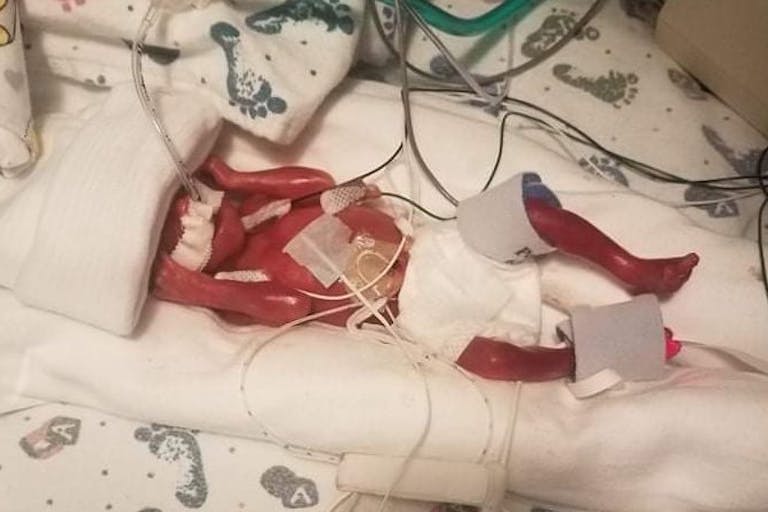 'Miracle' baby Jaden 23 weeks. photo via caring bridge