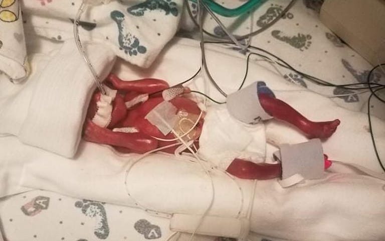 'Miracle' baby Jaden 23 weeks. photo via caring bridge