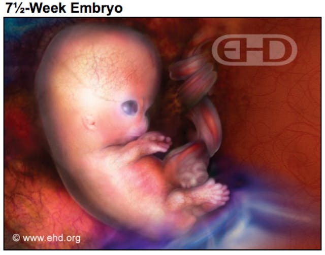 More real photos at www.ehd.org
