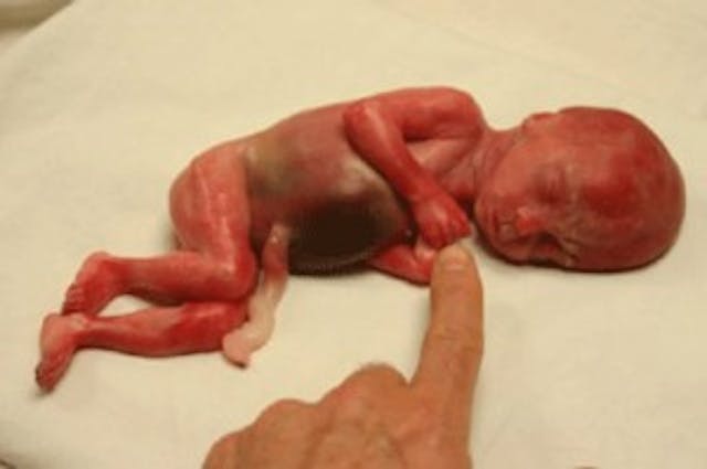 Two abortion survivors, denied medical care, died in the name of ‘choice’ image