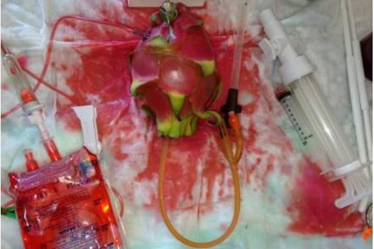 TEACH UCSF abortion training uses pitaya of dragonfruit to simulate abortion complications Image: TEACH UCSF abortion training uses pitaya of dragonfruit to simulate abortion complications