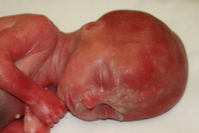 Close up of baby Rowan abortion survivor