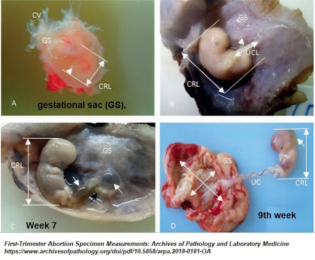 First trimester embryo pathology (Image credit: Arch Pathol Lab Med) Image: First trimester embryo pathology (Image credit: Arch Pathol Lab Med)
