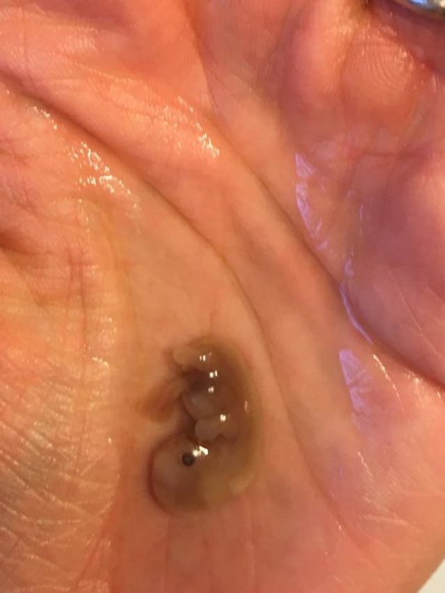 Author’s baby miscarried at 8 weeks, 2 days miscarriage
