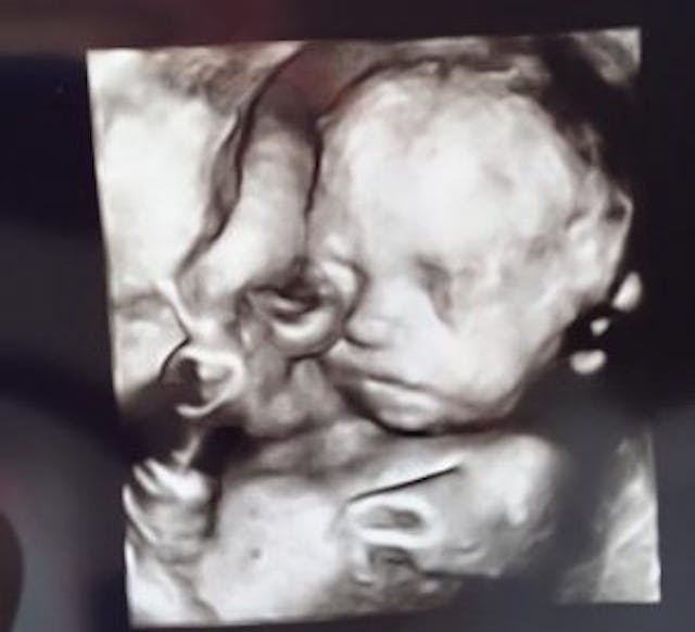 Baby Jonah in the womb via Facebook.