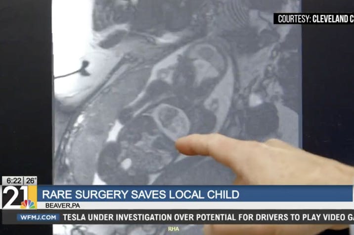 Ohio, prenatal heart surgery