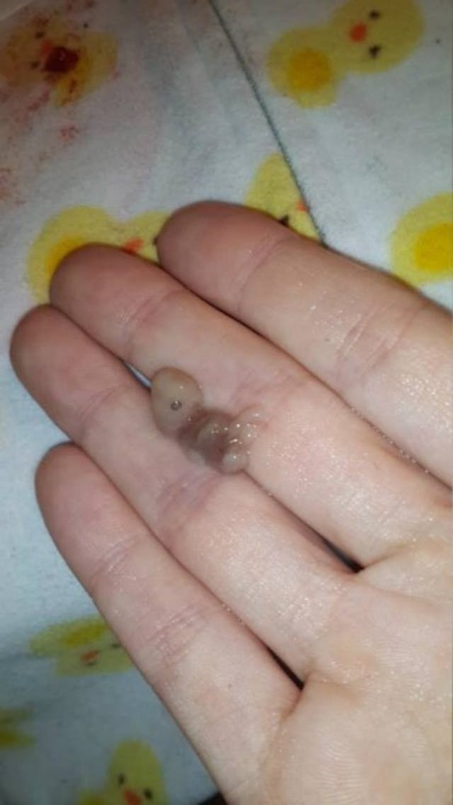 Images of abortion victims aren’t fake. These abortion industry photos prove it. image