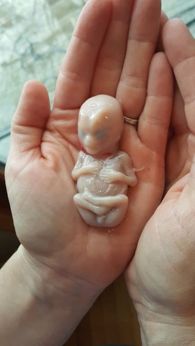 Miran, miscarried at 14 weeks Miran, miscarried at 14 weeks