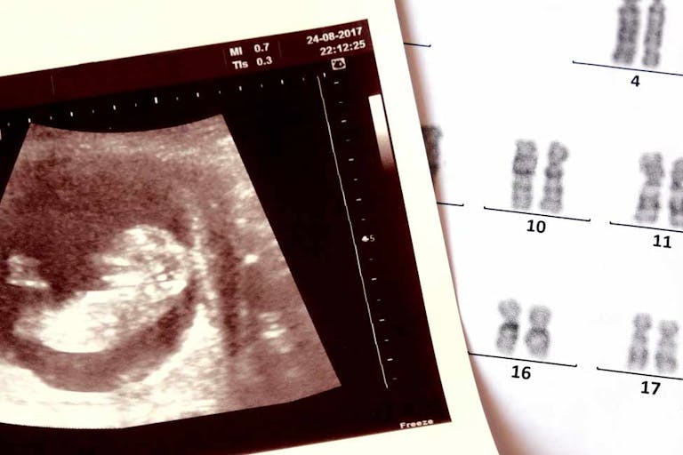 abortion, pregnancy, Louisiana, ultrasound, heartbeat