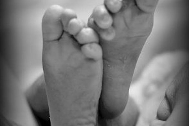 ambra4-anencephaly