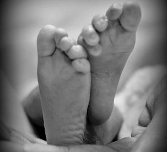 ambra4-anencephaly