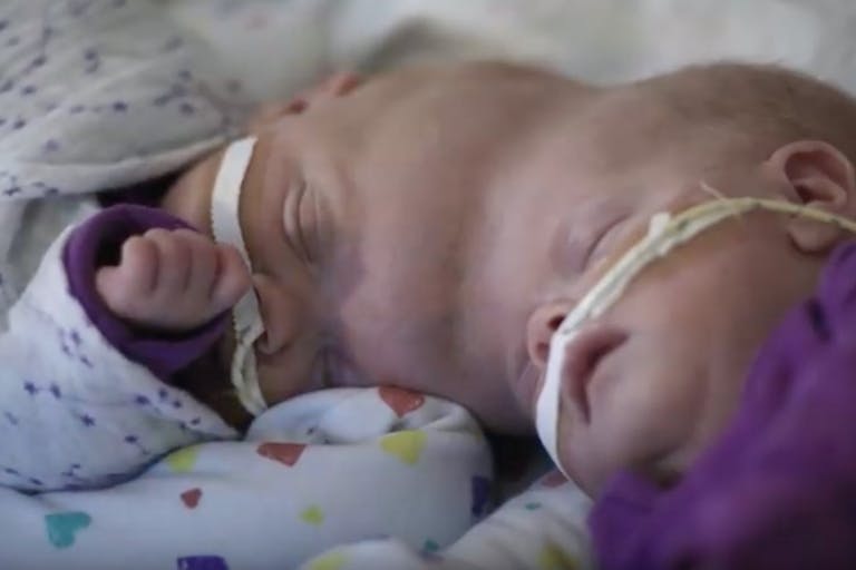 conjoined-twins-delaney