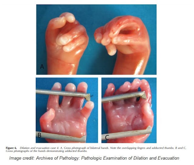 Second trimester D&E abortion specimen fetal hands (Image credit: Archives of Pathology) Image: Second trimester D+A abortion specimen fetal hands (Image credit: Archives of Pathology)