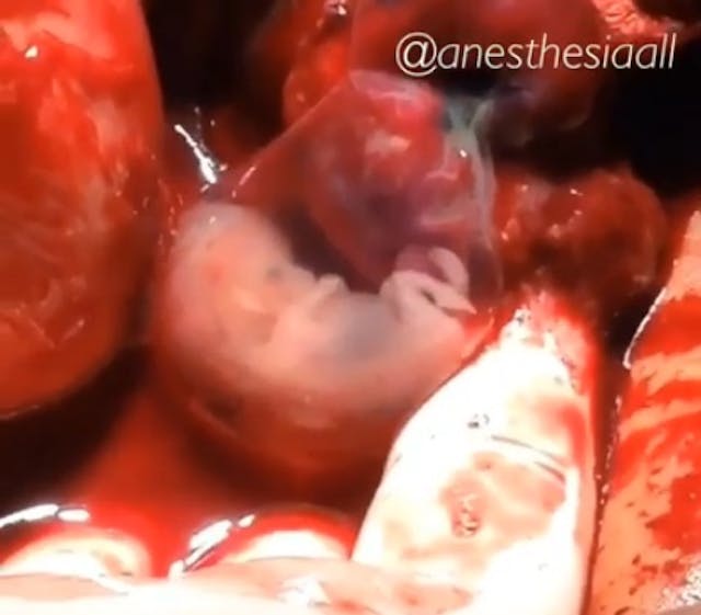 Image: Unborn child ectopic pregnancy 8 weeks