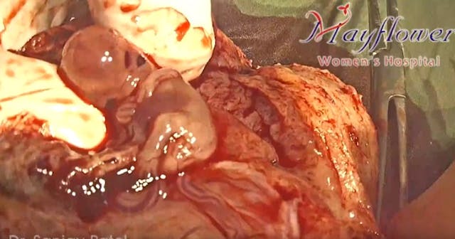 Preborn baby, ectopic pregnancy, 9 weeks Image:Preborn baby ectopic pregnancy 9 weeks gestation