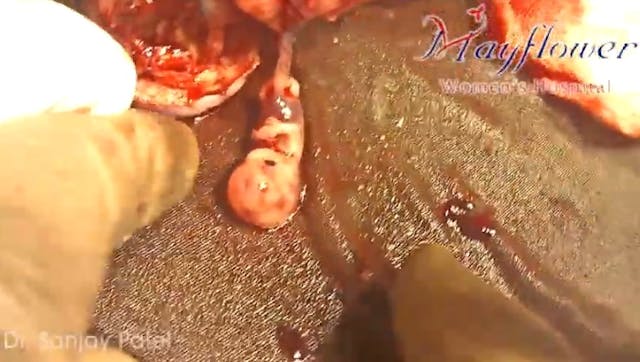 Image: Preborn baby ectopic pregnancy 9 weeks gestation