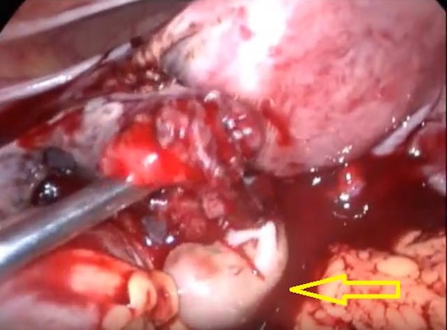 Preborn baby ectopic pregnancy 10 weeks gestation Image: Preborn baby ectopic pregnancy 10 weeks gestation