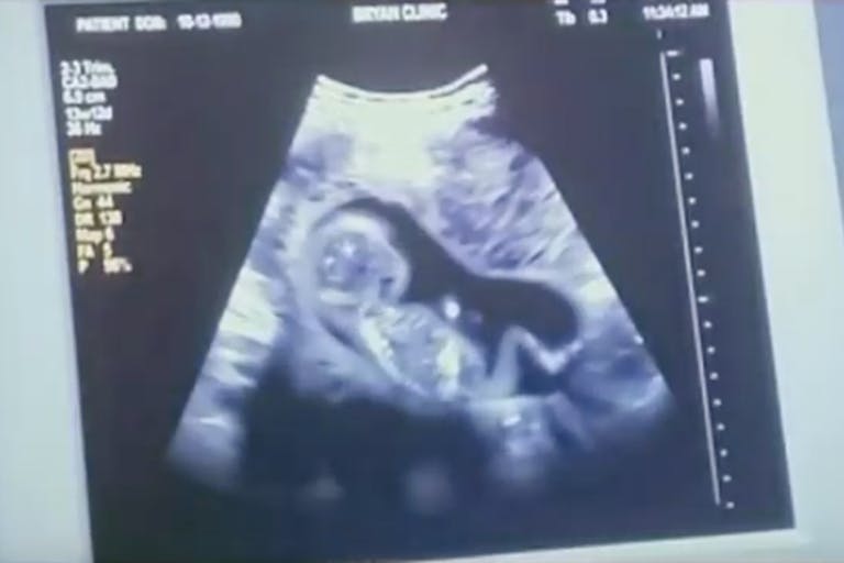 Unplanned abortion