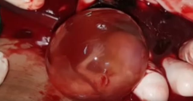 Image: Preborn baby ectopic pregnancy 11 weeks gestation