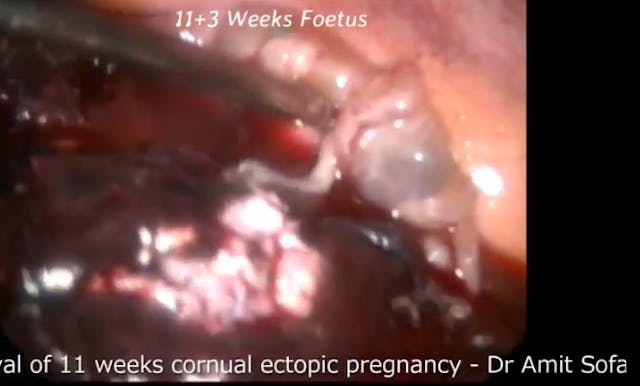 Image: Preborn baby ectopic pregnancy 11 weeks gestation