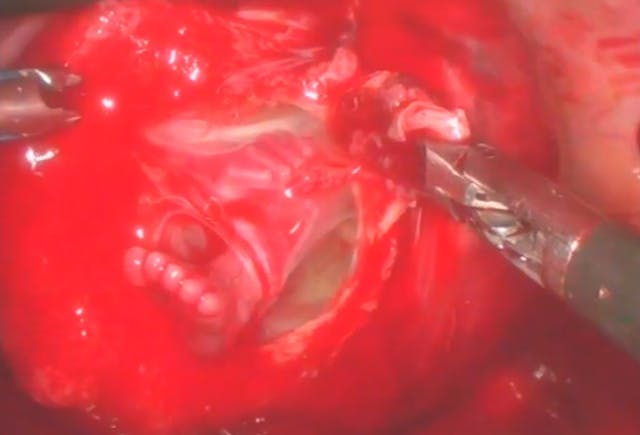 Preborn baby’s foot, ectopic pregnancy, 13 weeks gestation Image: Preborn baby foot ectopic pregnancy 13 weeks gestation