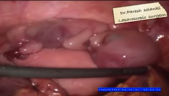 Image: Preborn baby ectopic pregnancy 14 weeks gestation