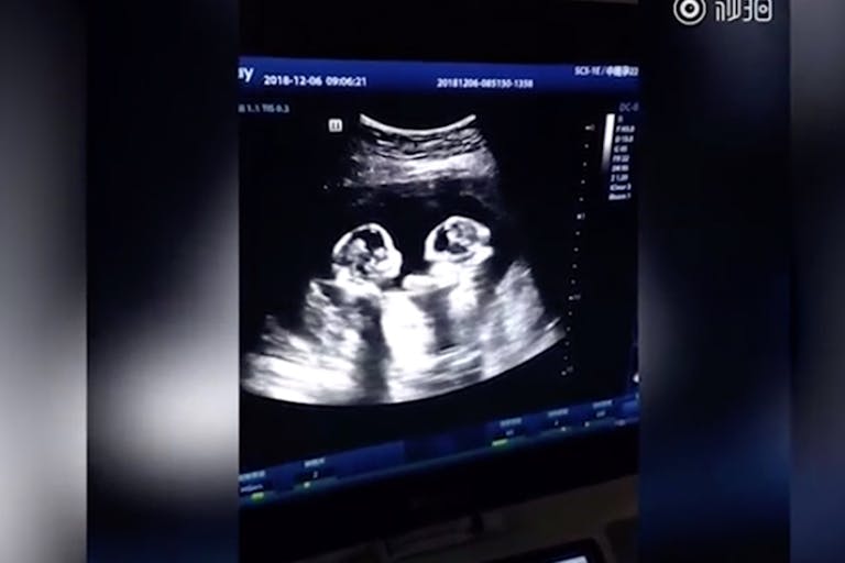 twins ultrasound