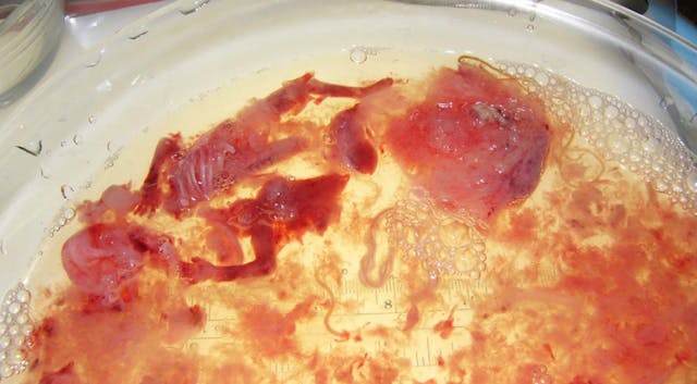 NAF Slide first trimester abortion 2. Visible are a ribcage, arms, and legs. USF Articles only Image: NAF Slide products of conception from abortion 2