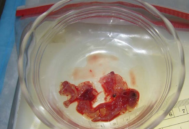 NAF Slide first trimester abortion 3. Visible are arms and hands. USF Articles only Image: NAF Slide products of conception from abortion 3